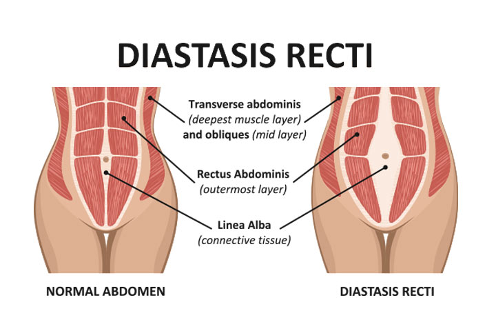 Diastasis Recti: A PostPartum Symptom No One Speaks About!