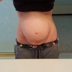 Diastasis Recti: A PostPartum Symptom No One Speaks About!